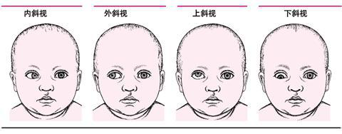 斜视病因是什么?